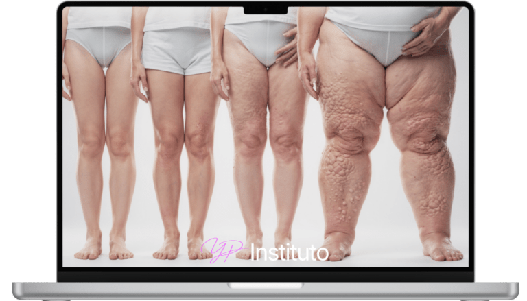 Os 5 Estágios do Lipedema: Identifique em Qual Você Está e Saiba Como Agir
